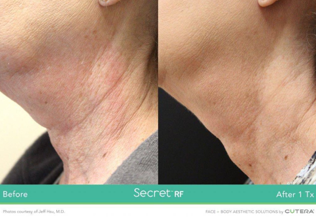 BEFORE AND AFTER IMAGES rf microneedling